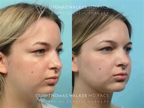 buccal fat removal 10 years later|Years Later, Buccal Fat Removal Regret! Dont do it!